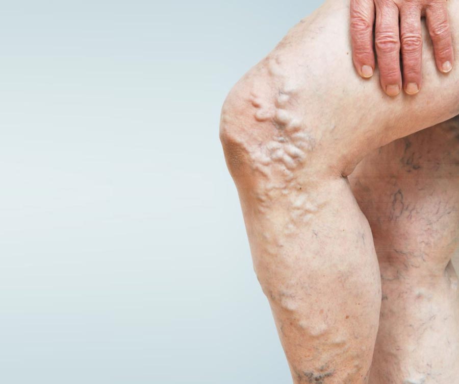 Everything you need to know about Chronic Venous Insufficiency (CVI)